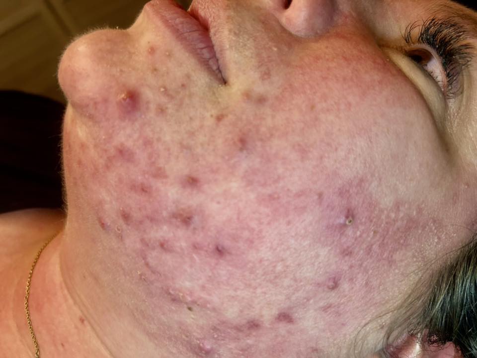 September Beauty Chic Microdermabrasion Acne face before