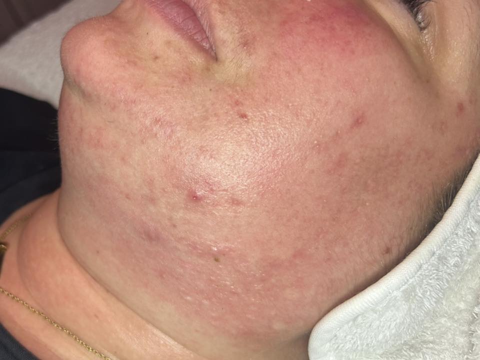 September Beauty Chic Microdermabrasion Acne face after