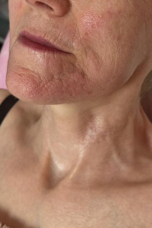 September Head to Toe Baillieston Collagen Lift ageing skin wrinkles rejuvenation chin radio frequency after