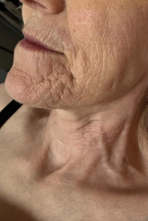 September Head to Toe Baillieston Collagen Lift ageing skin wrinkles rejuvenation chin radio frequency before