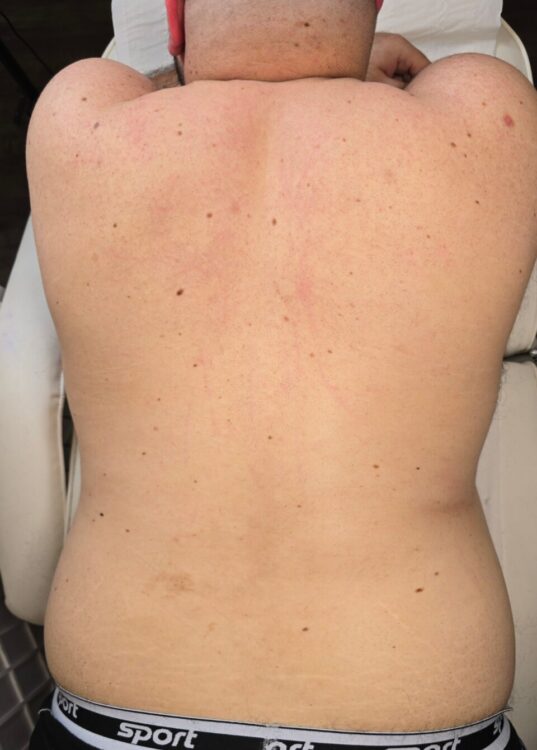September Ice Aesthetics intense pulsed light unwanted hair back after