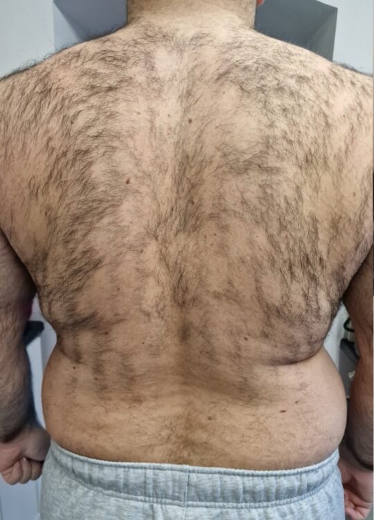 September Ice Aesthetics intense pulsed light unwanted hair back before