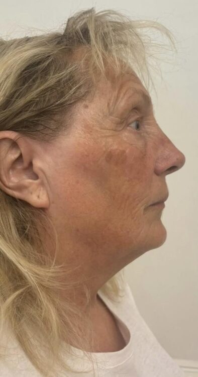 September Lous Beautique fine lines and wrinkles Collagen Lift radio frequency treatment results after