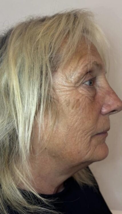 September Lous Beautique fine lines and wrinkles Collagen Lift radio frequency treatment results before