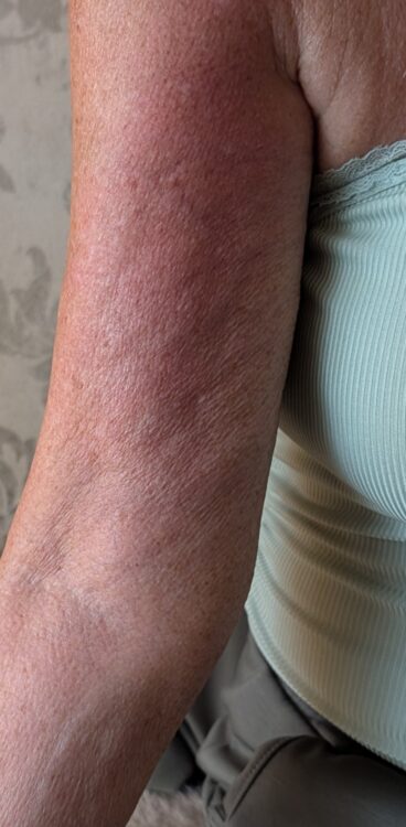 September Loves Beauty Anita Collagen Lift arm rejuvenation skin tightening radio frequency results after