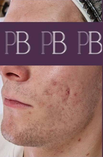perrys beauty after oct 25