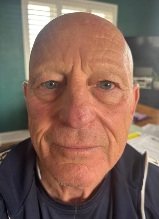 JANUARY 2026 Dale Evans Skin Specialist Collagen Lift radio frequency facial male results healthy skin after
