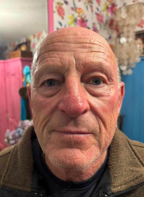 JANUARY 2026 Dale Evans Skin Specialist Collagen Lift radio frequency facial male results healthy skin before