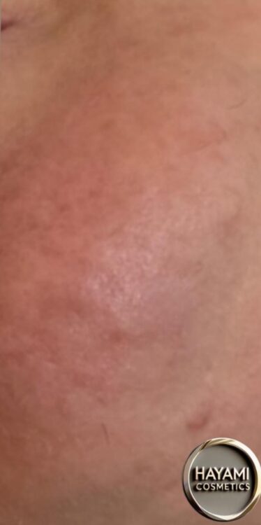 JANUARY 2026 Hayami cosmetics unwanted facial hair intense pulsed light treatment results after