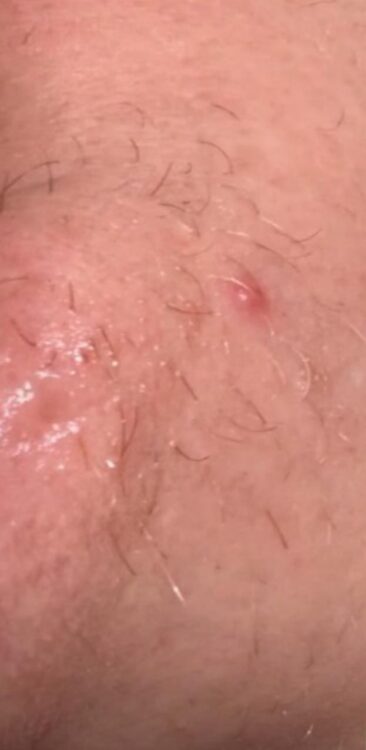 JANUARY 2026 Hayami cosmetics unwanted facial hair intense pulsed light treatment results before