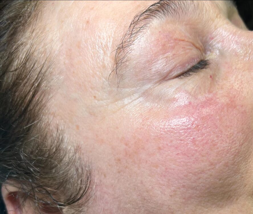 JANUARY 2026 KARMA BEAUTY THERAPY COLLAGEN LIFT EYES fine lines and wrinkles skin rejuvenation skinbase after
