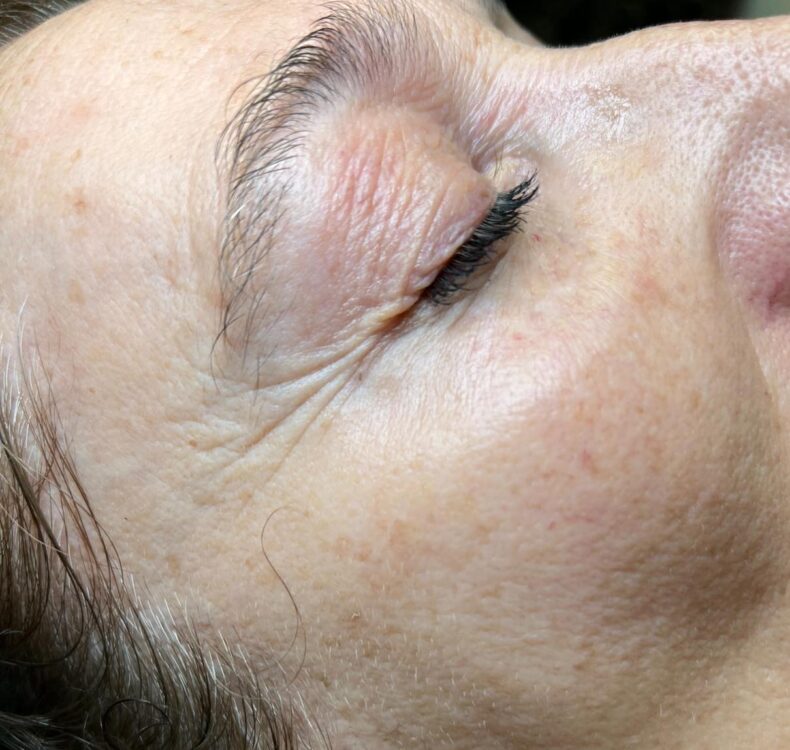JANUARY 2026 KARMA BEAUTY THERAPY COLLAGEN LIFT EYES fine lines and wrinkles skin rejuvenation skinbase before