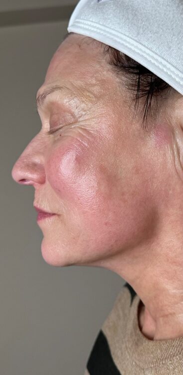 JANUARY 2026 Preen Aesthetics Collagen Lift radio-frequency facial for ageing skin results after