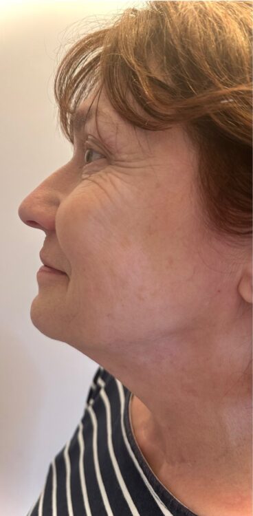 JANUARY 2026 Preen Aesthetics Collagen Lift radio-frequency facial for ageing skin results before