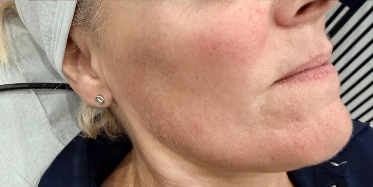 JANUARY 2026 TM Aesthetics and Beauty Collagen Lift Mouth fine lines and wrinkles rejuvenating radio-frequency treatment after