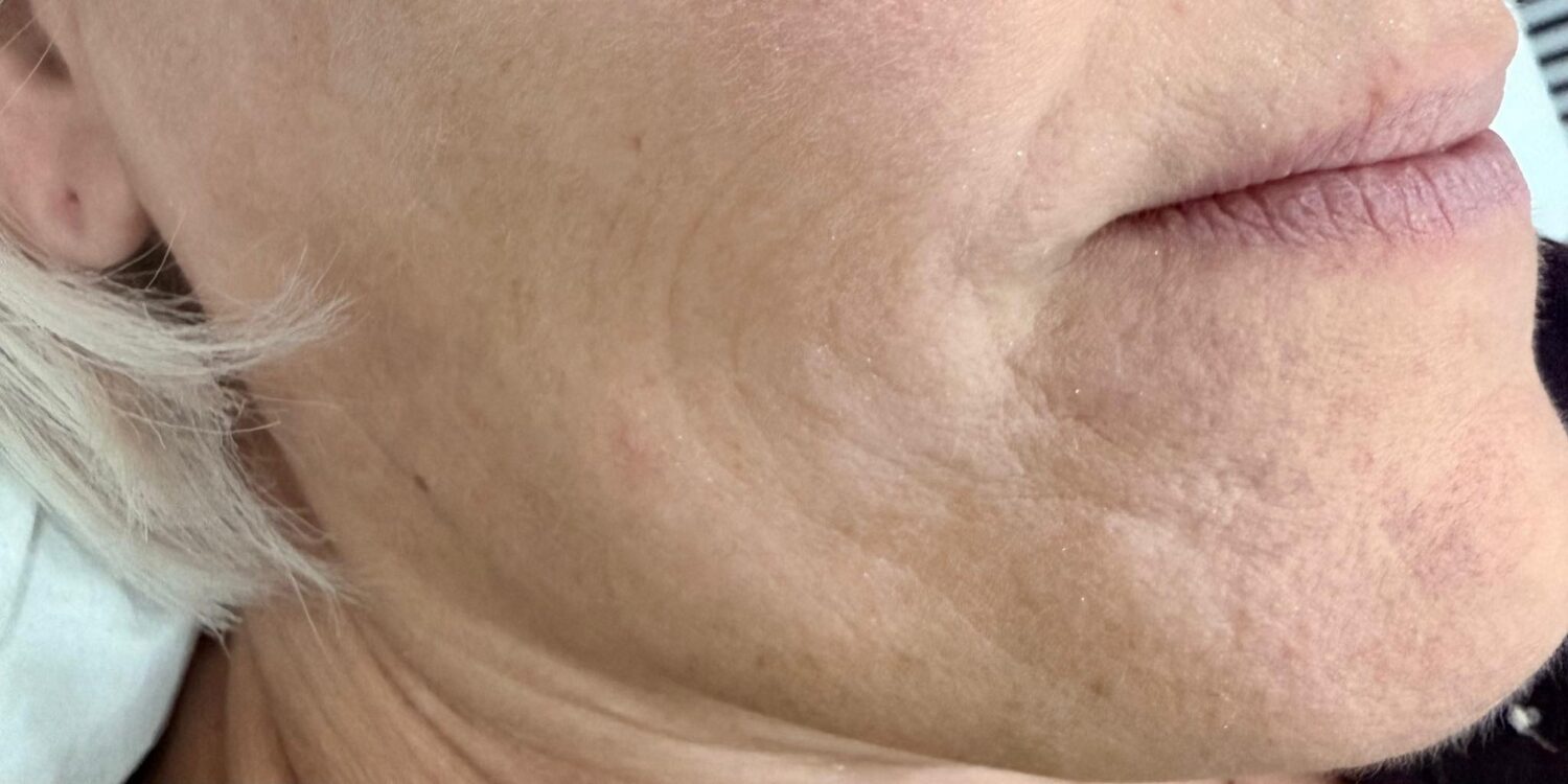 JANUARY 2026 TM Aesthetics and Beauty Collagen Lift Mouth fine lines and wrinkles rejuvenating radio-frequency treatment before