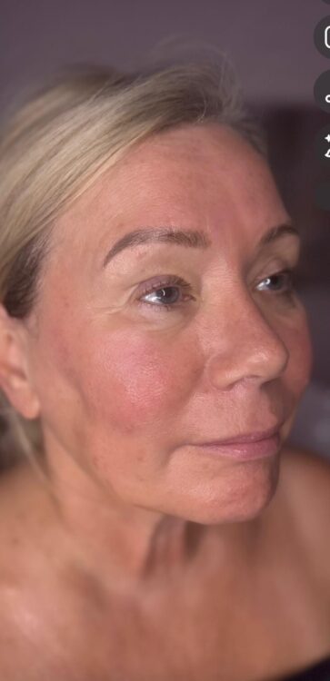 JANUARY 2026 urban luxe collagen lift radio-frequency facial transformation after