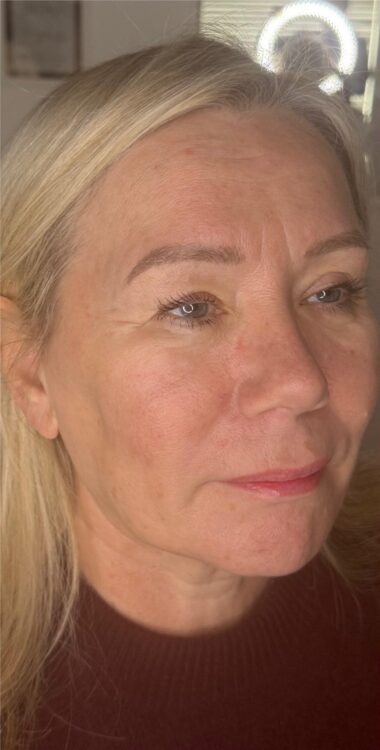 JANUARY 2026 urban luxe collagen lift radio-frequency facial transformation before
