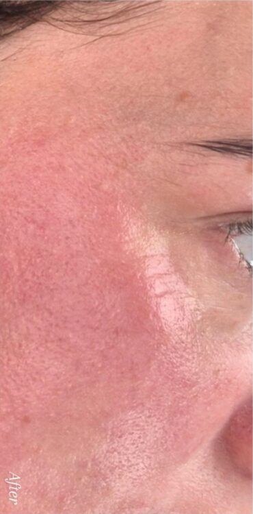 January 2026 Nicola Hansom Beauty Microdermabrasion face milia extraction results after