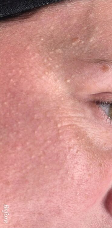 January 2026 Nicola Hansom Beauty Microdermabrasion face milia extraction results before