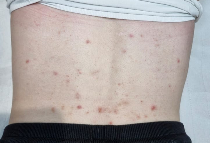 January 2026 Perry's Beauty IPL Acne back treatment results before
