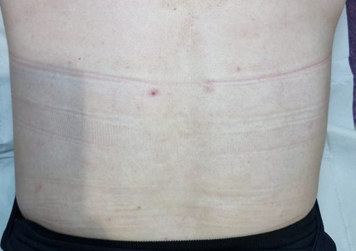 January 2026 Perry's Beauty IPL Acne back treatment results after