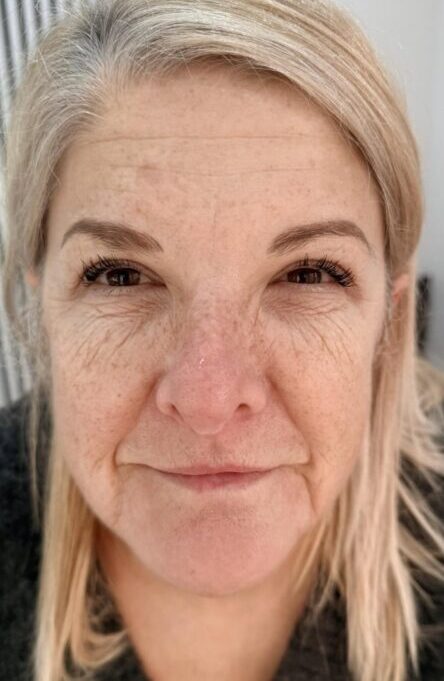 January 2026 T M Aesthetics and Beauty 2 Paula Collagen Lift ageing skin transformation radio-frequency glowing skin before