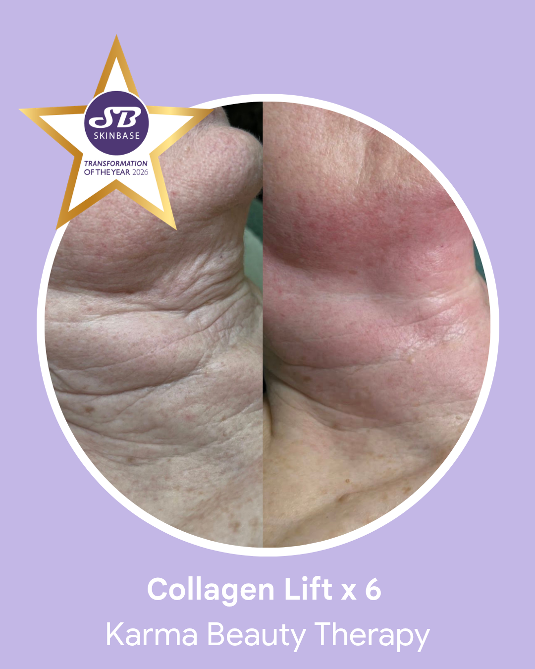march-2026-karma-beauty-therapy-neck-rejuvenation-2