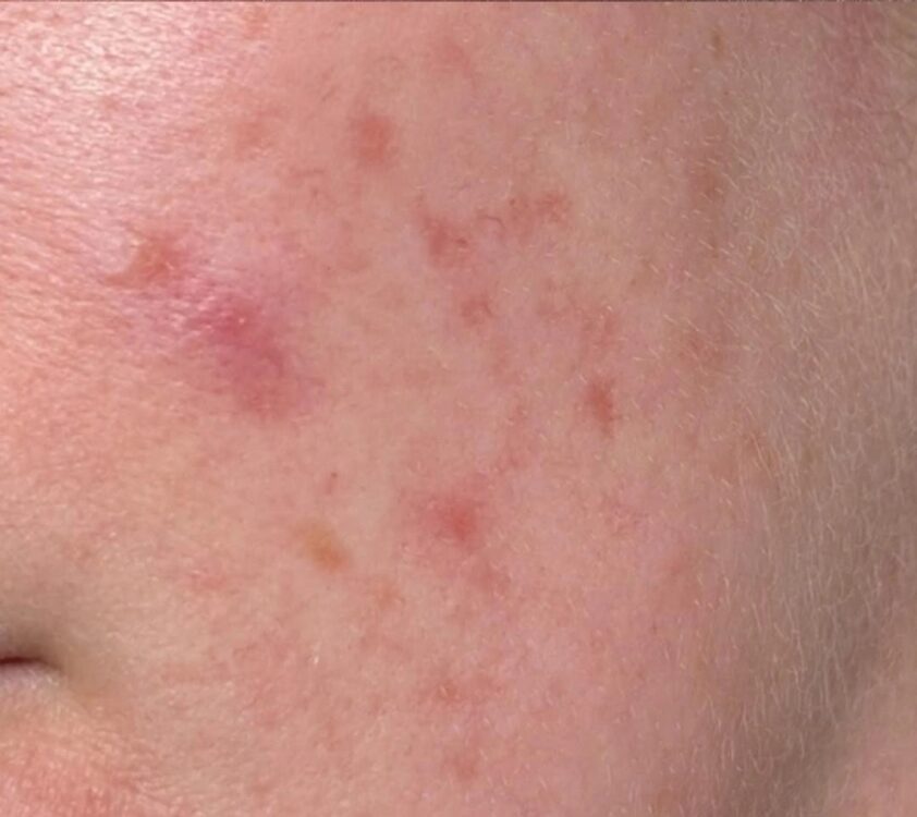 February 2026 Bear Beauty Microdermabrasion acne exfoliation facial transformation after