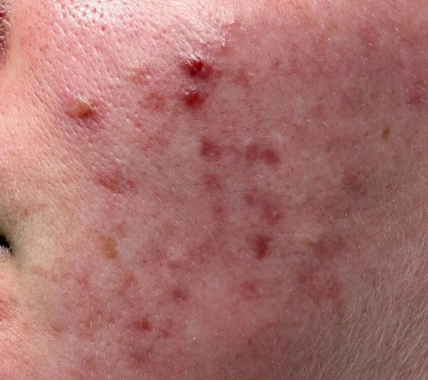 February 2026 Bear Beauty Microdermabrasion acne exfoliation facial transformation before