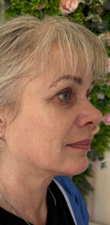 February 2026 English Rose Beauty Collagen Lift ageing skin rejuvenation non-surgical radio-frequency facial before