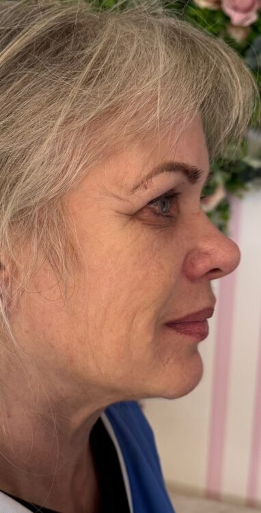 February 2026 English Rose Beauty Collagen Lift ageing skin rejuvenation non-surgical radio-frequency facial before