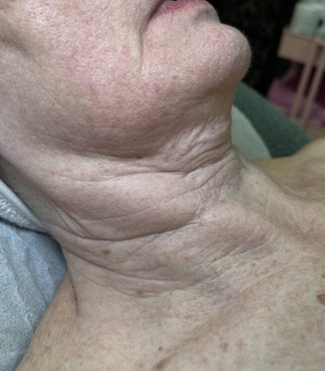 February-2026-Karma-Beauty-Therapy-Collagen-Lift-Neck-Radio-Frequency-Non-Surgical-Rejuvenation-Before
