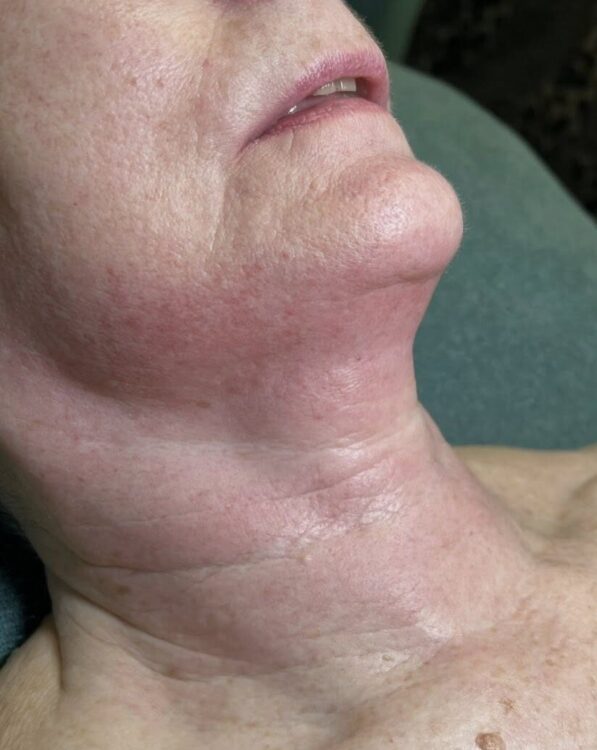 February-2026-Karma-Beauty-Therapy-Collagen-Lift-Neck-Radio-Frequency-Non-Surgical-Rejuvenation-after