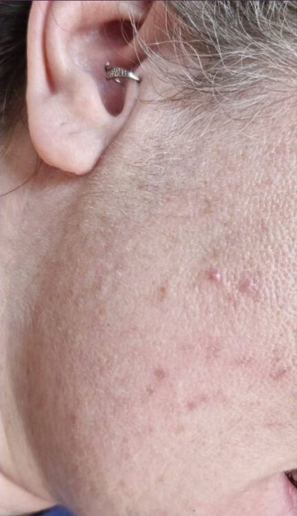 February 2026 Perry's Beauty Unwanted Facial Hair Intense Pulsed Light Results After