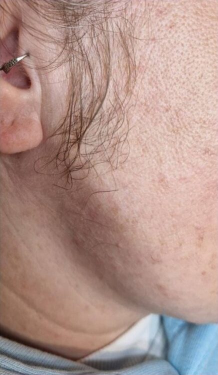 February 2026 Perry's Beauty Unwanted Facial Hair Intense Pulsed Light Results Before