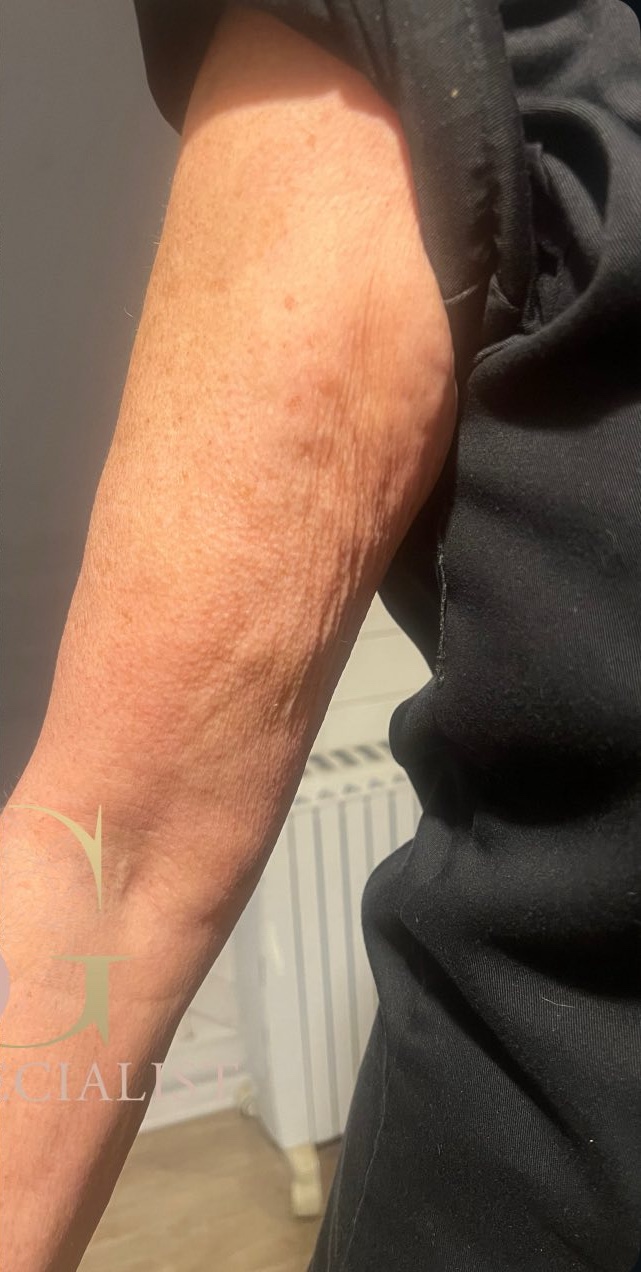 February 2026 SG skin specialist collagen lift arms skin laxity non-surgical rejuvenation after