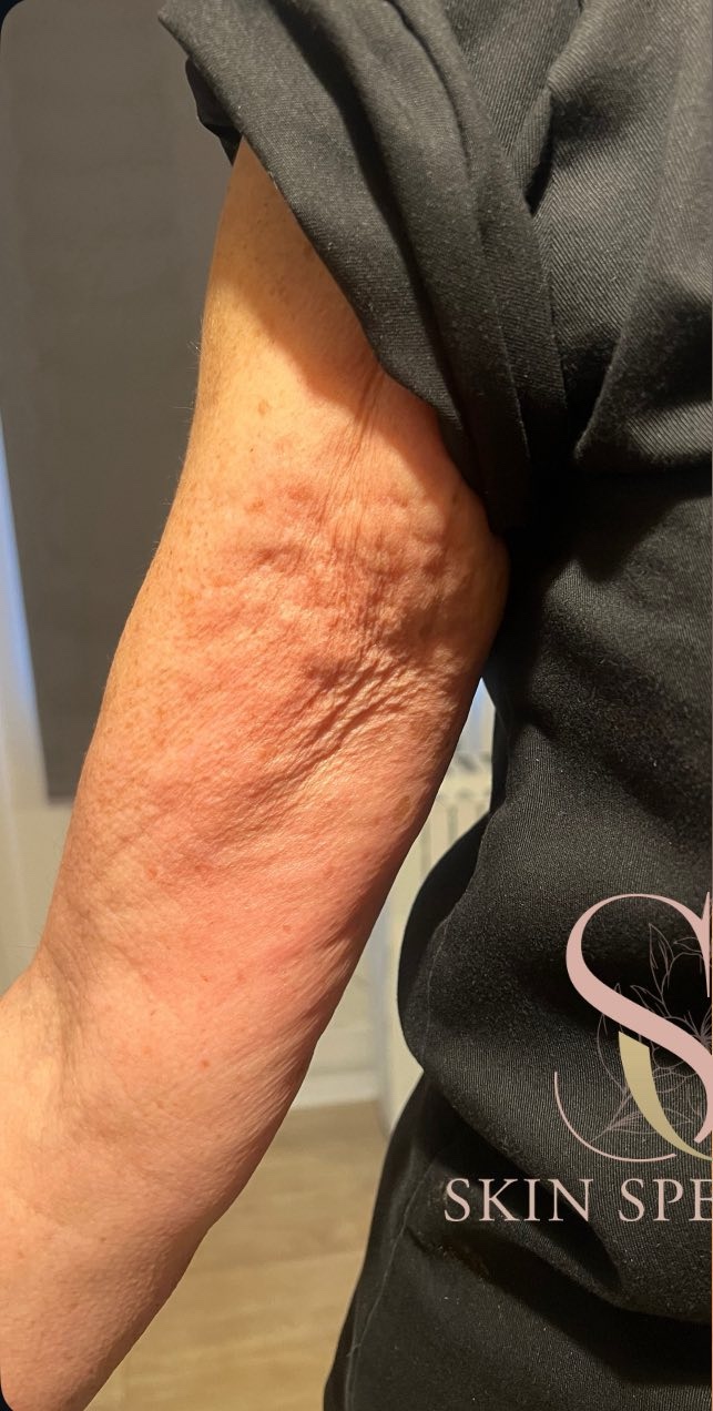 February 2026 SG skin specialist collagen lift arms skin laxity non-surgical rejuvenation before