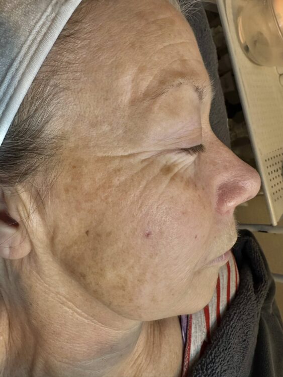February 2026 TLV Beauty Microdermabrasion Ageing Skin Fine Lines and Wrinkles Exfoliating Facial Rejuvenation Before