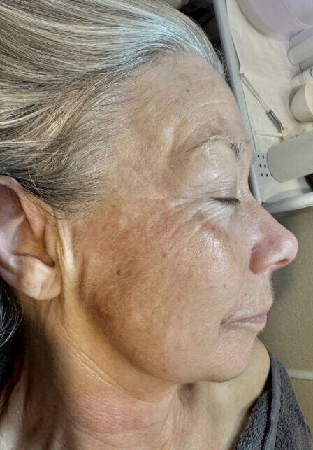February 2026 TLV Beauty Microdermabrasion Ageing Skin Fine Lines and Wrinkles Exfoliating Facial Rejuvenation after