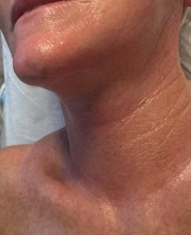 February-2026-luna-laser-clinic-collagen-lift-neck-rejuvenation-non-surgical-transformation-radio-frequency-energy-results-after