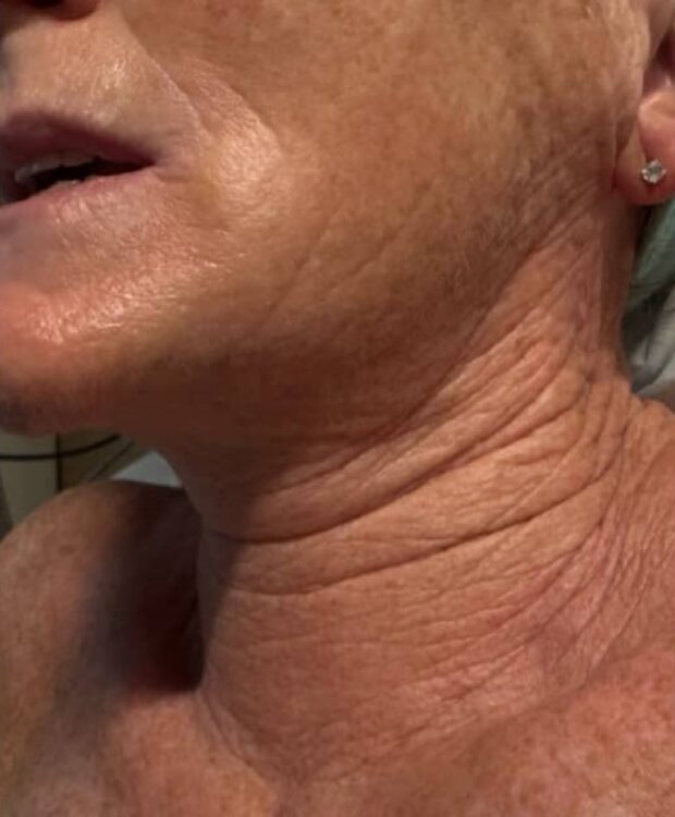 February-2026-luna-laser-clinic-collagen-lift-neck-rejuvenation-non-surgical-transformation-radio-frequency-energy-results-before