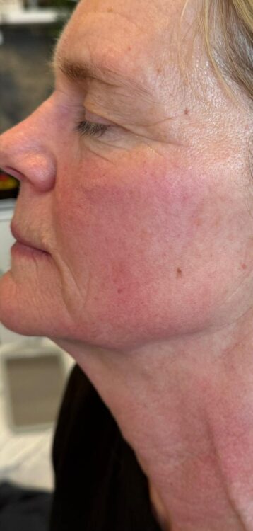 March 2026 Beauty at the Suite Ageing Crepey Skin Collagen Lift Radio Frequency for Fine Lines and Wrinkles Results After