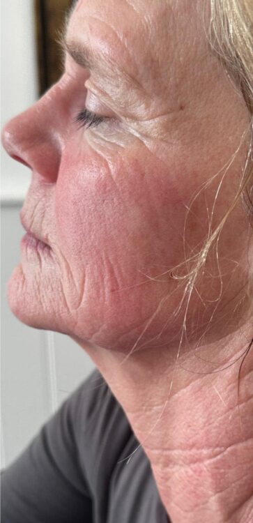 March 2026 Beauty at the Suite Ageing Crepey Skin Collagen Lift Radio Frequency for Fine Lines and Wrinkles Results Before