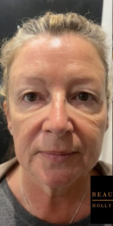 March 2026 Beauty by Holly Nicole Collagen Lift Facial for Rejuvenating Ageing Skin Before