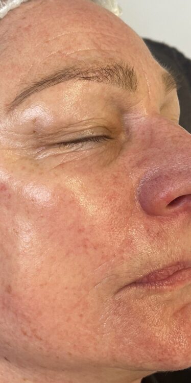 March 2026 Beauty by Nicola SkinBase Microdermabrasion Resurfacing Treatment for Fine Lines and Wrinkles Results After