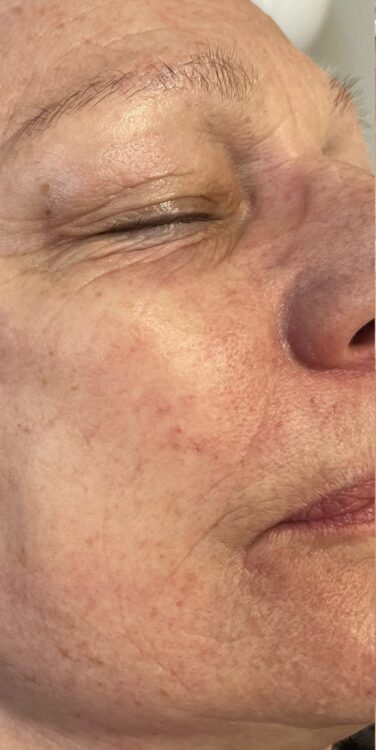 March 2026 Beauty by Nicola SkinBase Microdermabrasion Resurfacing Treatment for Fine Lines and Wrinkles Results Before
