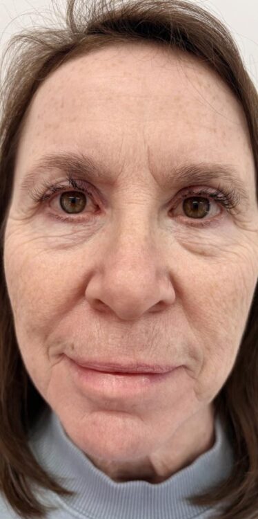 March 2026 Clarissa's beauty Boutique Microdermabrasion for ageing skin results before