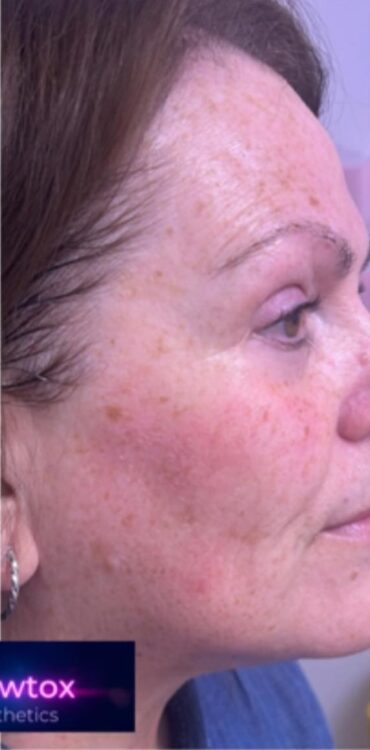 March-2026-Glowtox-Aesthetics-Collagen-Lift-Skin-Rejuvenation-Fine-Lines-and-Wrinkles-Treatment-Non-Surgical-results-after