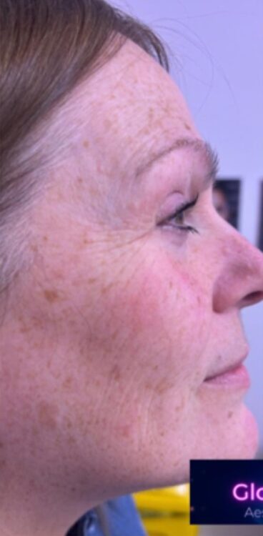 March-2026-Glowtox-Aesthetics-Collagen-Lift-Skin-Rejuvenation-Fine-Lines-and-Wrinkles-Treatment-Non-Surgical-results-Before